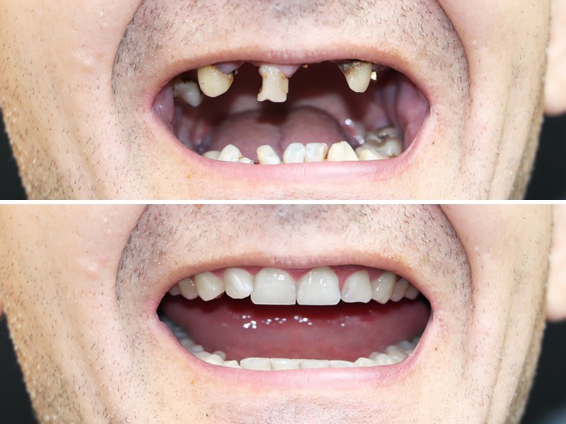 What is a Full Mouth Reconstruction?