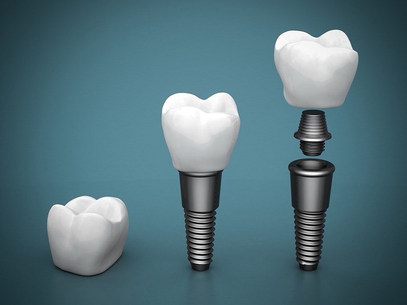 Recovery Time from Dental Implants
