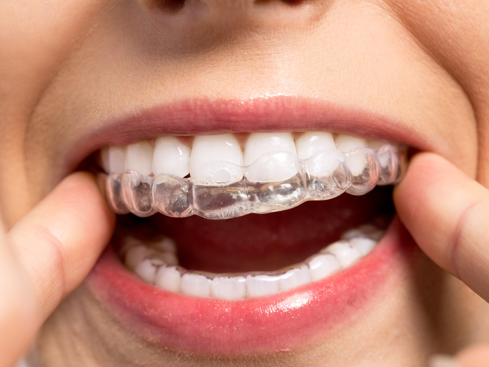 Does the First Invisalign tray move your teeth?