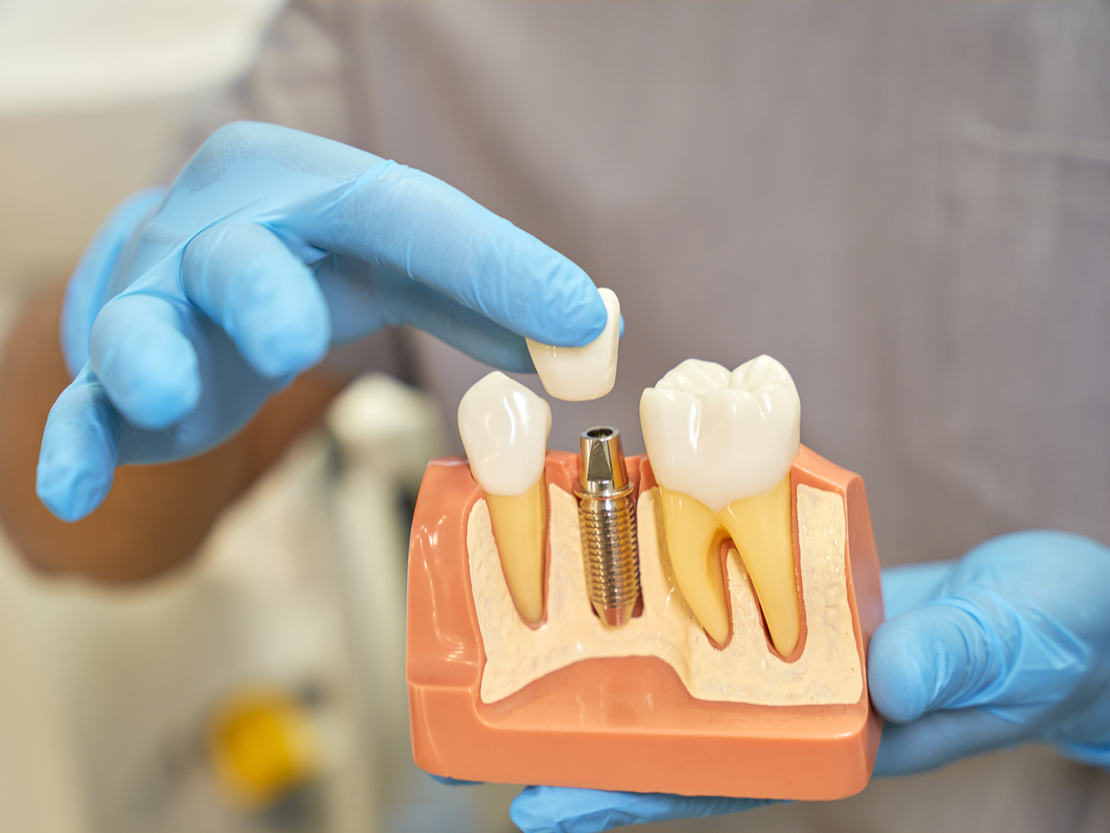 Are Dental Implants Right for You?