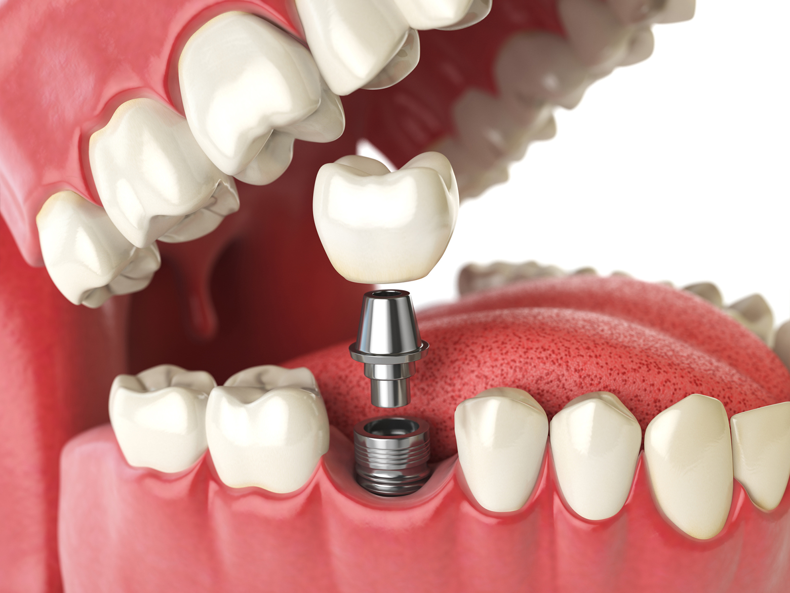 If You Have Gum Disease, Can You Get Dental Implants?