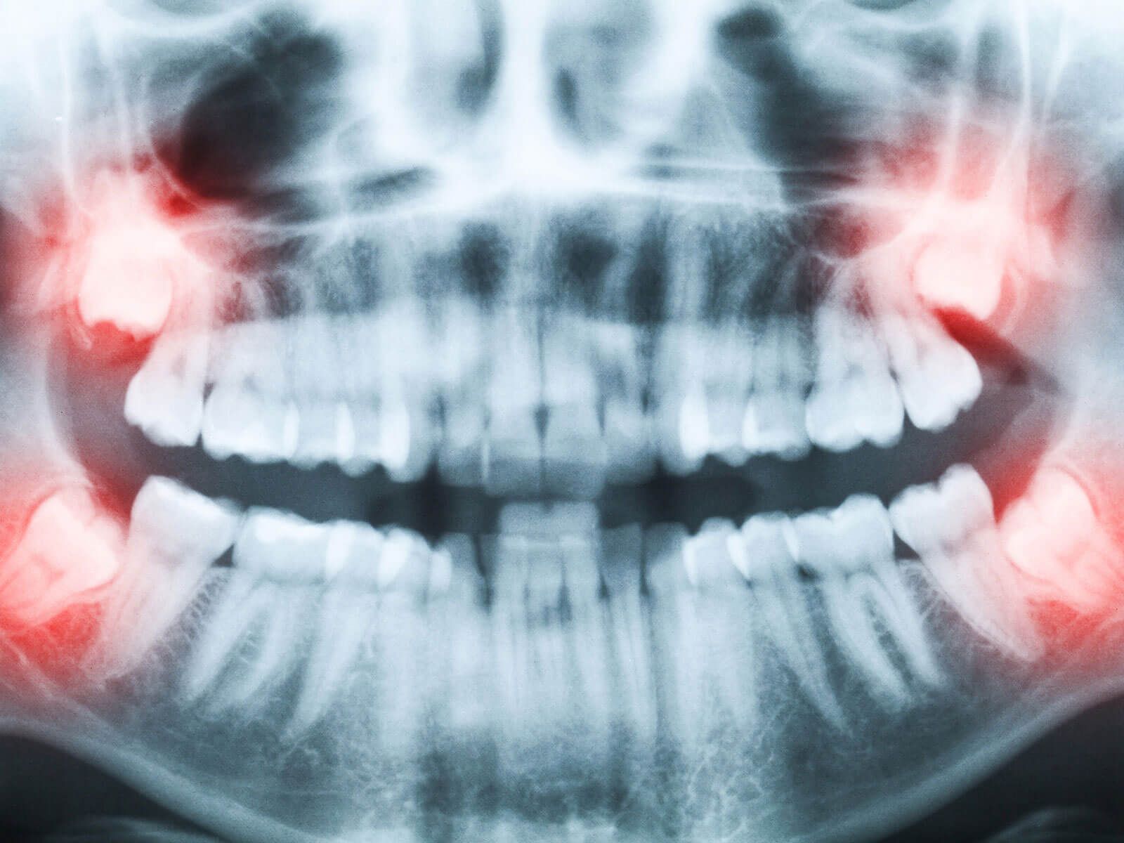 Is It Safe To Remove All Four Wisdom Teeth At Once?