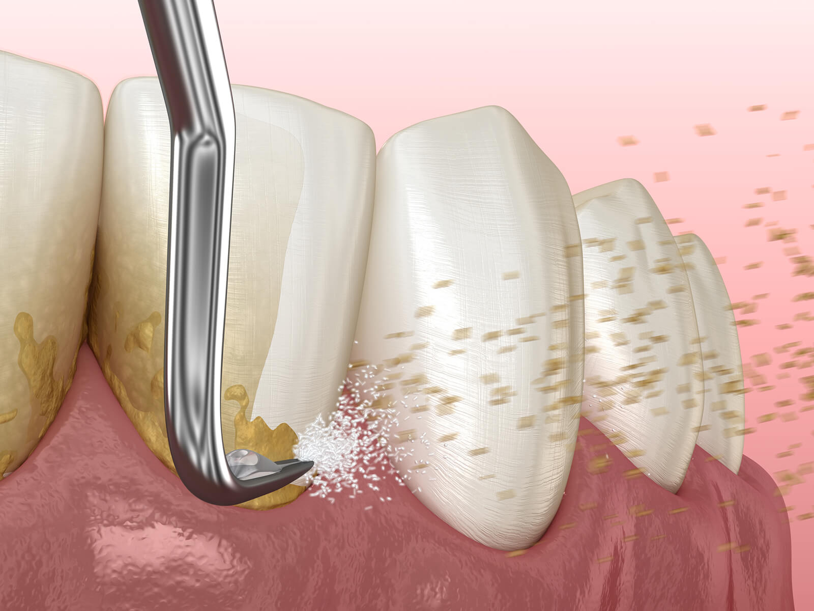 Maintaining Your Bright Smile: Insights on Tartar Removal from Teeth at Home