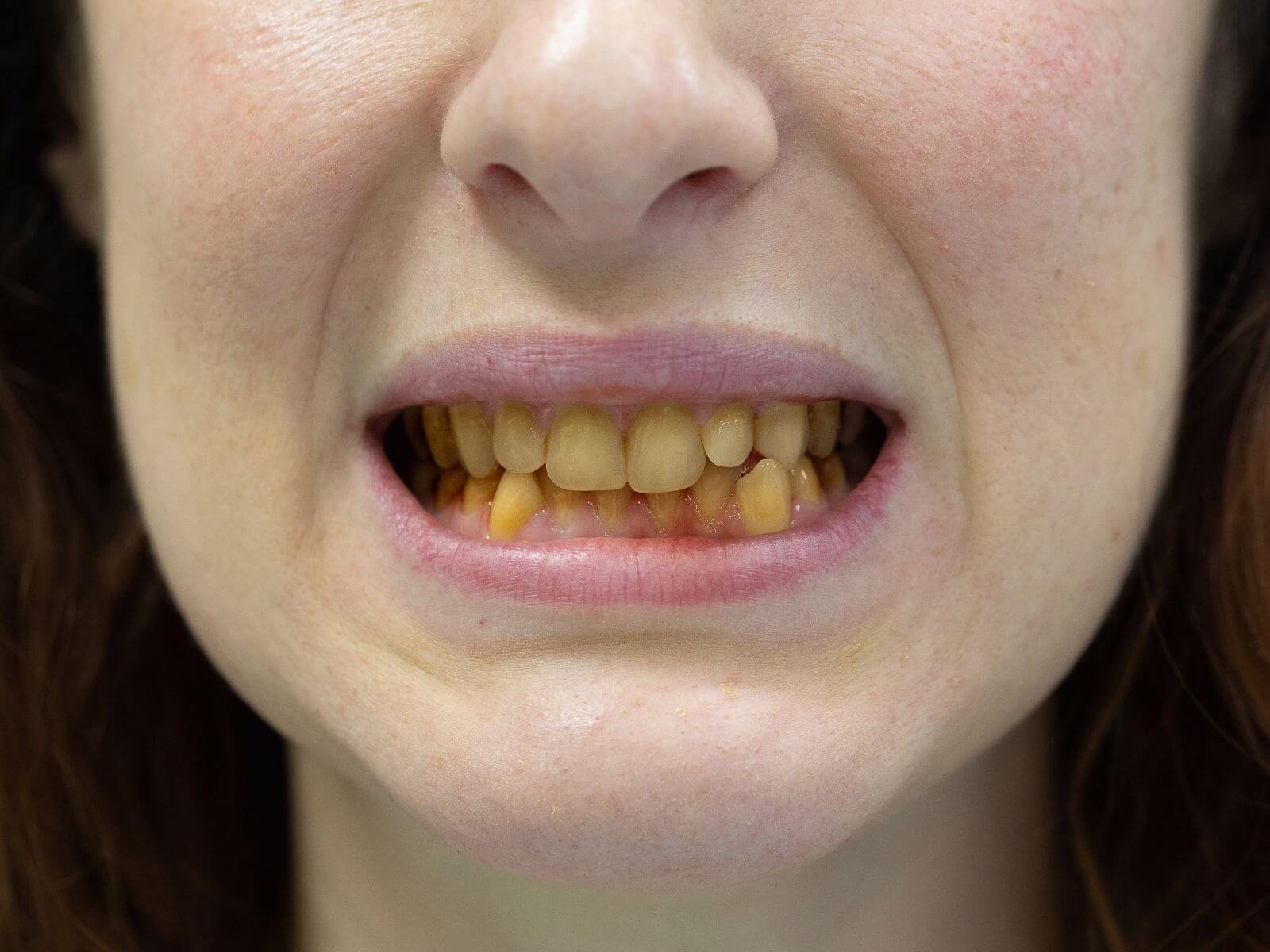 A Look At Tooth Discoloration And It’s Possible Causes