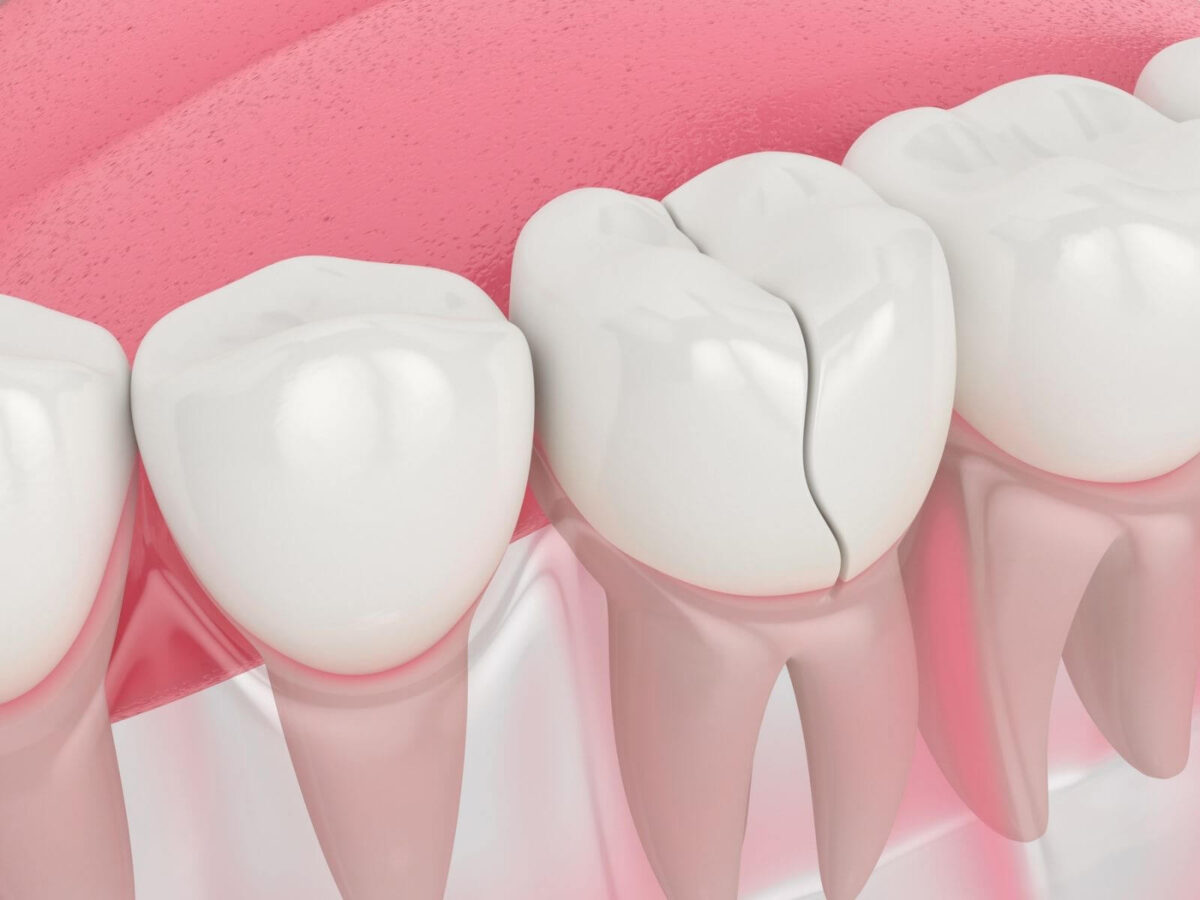Cracked Tooth Treatment Options: What You Need to Know