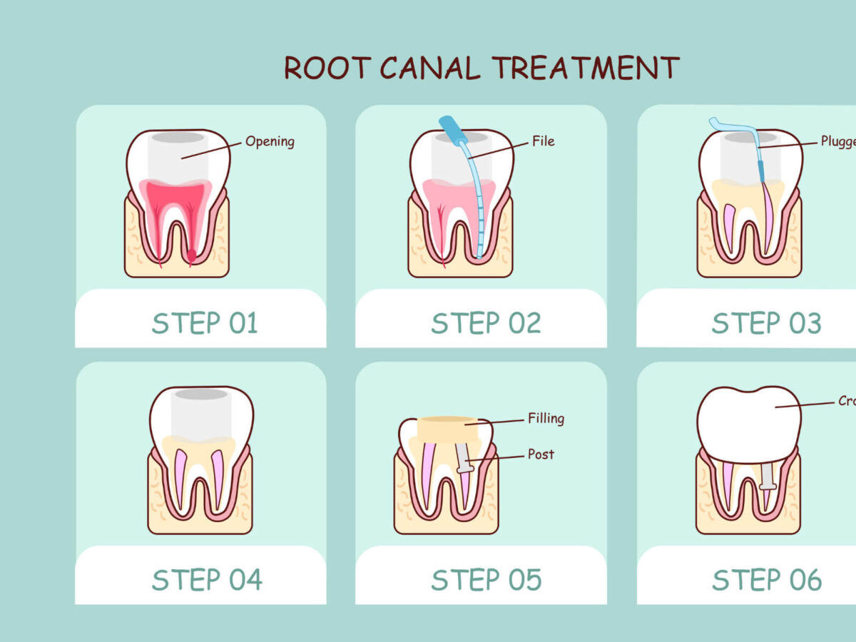 Best Food to Eat After Root Canal Treatment