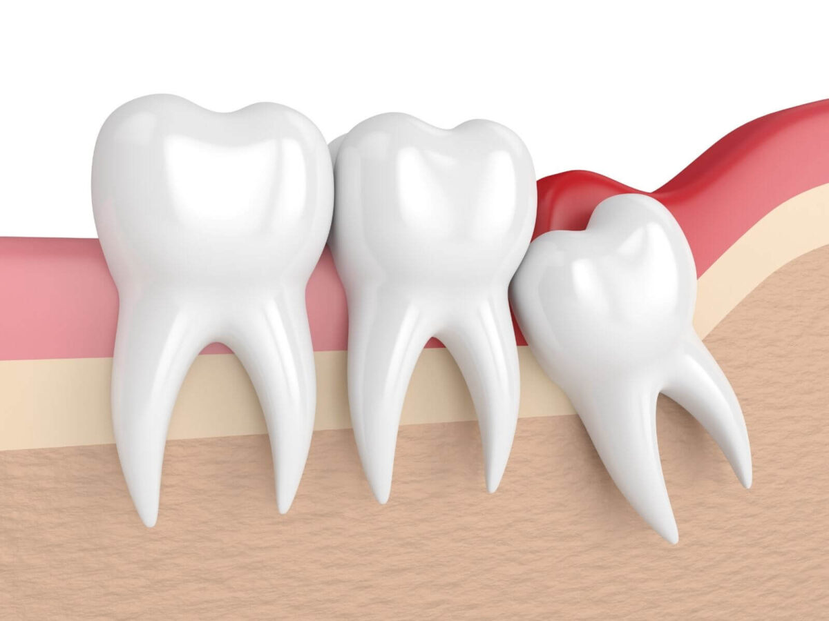 Wisdom Teeth Removal: When And Why It’s Necessary