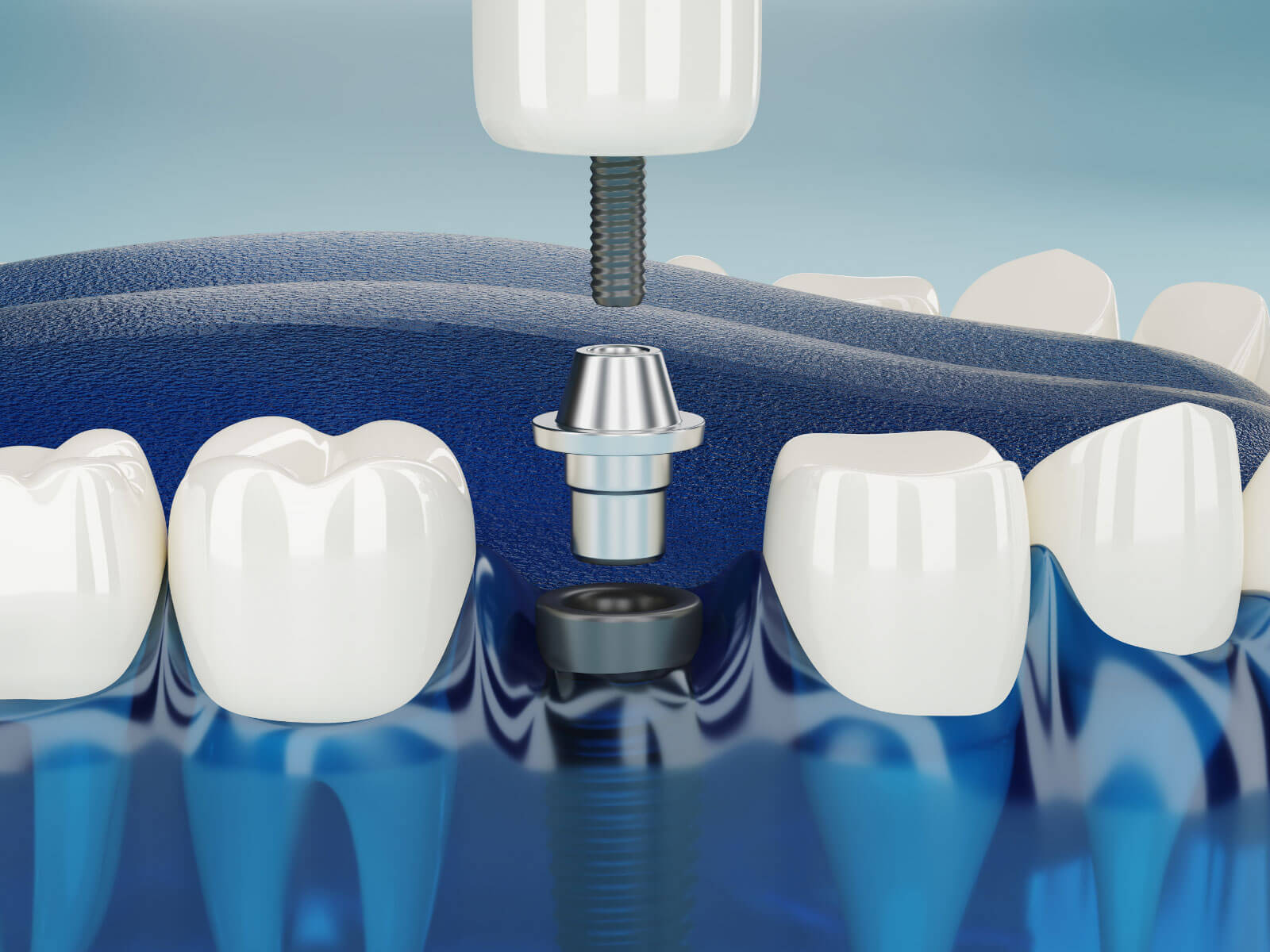 Different Types of Dental Implants: 6 Options Explained