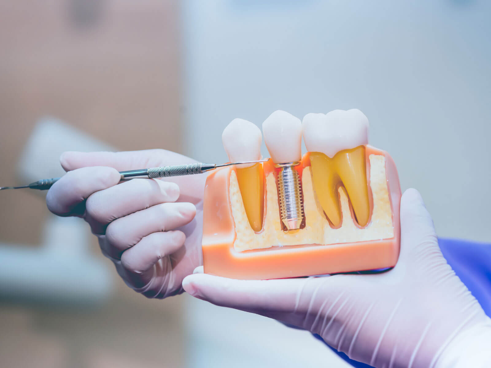 How Screwless Dental Implants Work: Complete Guide